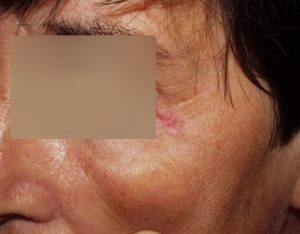 Figura 9. Mujer de 55 años con carcinoma basocelular nodular en canto externo de ojo I. 2 sesiones de TFD.