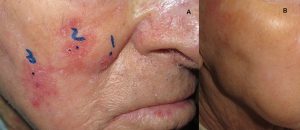 Figura 15. A: varón de 82 años con enfermedad de Bowen (3 lesiones) en mejilla derecha. 2 sesiones de TFD. B: control iconográfico a los 38 meses tras tratamiento: resolución de la lesión. Sólo se objetivan cicatrices de biopsias.
